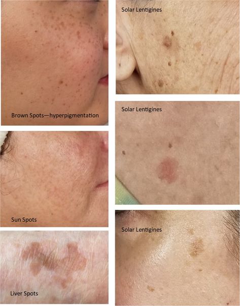 People With Red Hair, Age Spots On Face, Body Inflammation, Skin Moles, Post Inflammatory Hyperpigmentation, Types Of Skin, Healthy Lifestyle Quotes, Brown Spots Removal, Brown Spots On Face