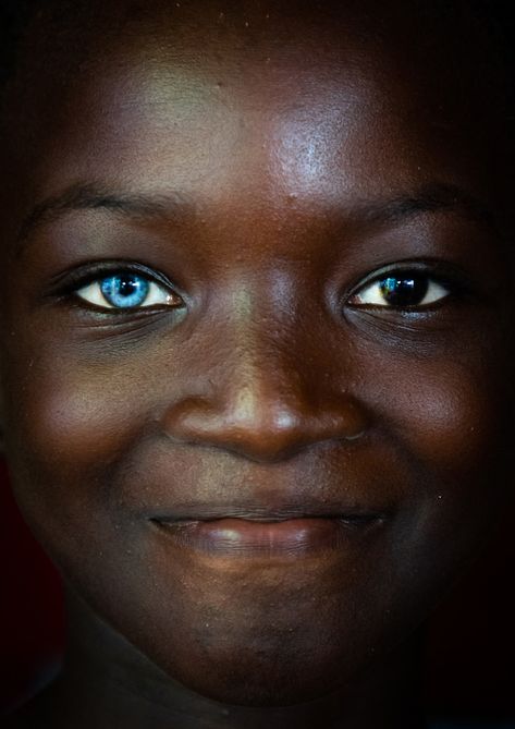 https://flic.kr/p/25nXam6 | Beautiful african girl with heterochromia iridis causing two different colored eyes, Moyen-Comoé, Abengourou, Ivory Coast | © Eric Lafforgue www.ericlafforgue.com Two Different Eye Colors People, Different Colour Eyes, Heterochromia Eyes, Two Different Colored Eyes, Rare Eye Colors, Rare Eyes, Exotic Hairstyles, Different Colored Eyes, Pretty Blue Eyes