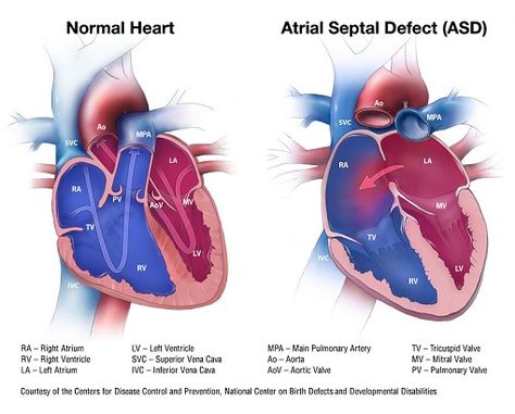 Atrial Septal Defect Blood Flow Through The Heart, Atrial Septal Defect, Nurse Brain Sheet, Chromosomal Abnormalities, Tricuspid Valve, Cardiovascular Disorders, Pediatric Physical Therapy, Chd Awareness, Normal Heart