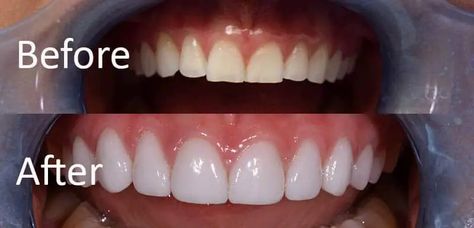 Veneers vs. dental crowns: Comparison and how to choose the best option for you Porcelain Crowns, Tooth Crown, Composite Veneers, Dental Bonding, Veneers Teeth, Porcelain Veneers, Burbank California, Dental Veneers, Dental Crowns