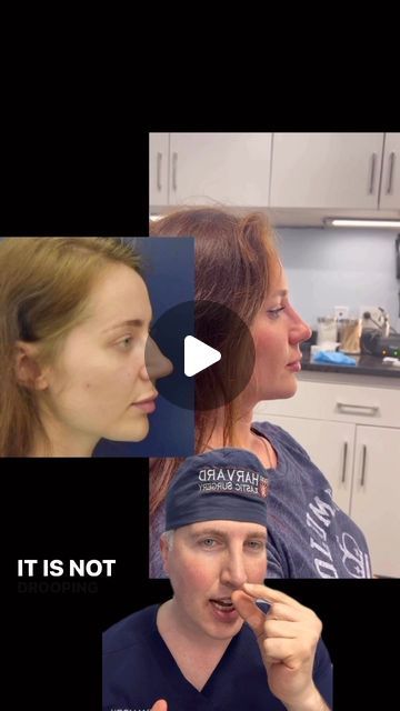 Dr. Richard Reish, M.D., FACS on Instagram: "Rhinoplasty:  1.5 years post-op. Nasal tip deprojection is a powerful and critical maneuver to perform in a patient with an over-projected and elongated tip 👍.  .  Please feel free to contact my office for a complimentary  consultation at 212-879-8506. . .  My personal Bio, full gallery of before and after pictures, and a list of procedures I perform can be found at the link on my Instagram homepage. . .  This is my actual patient with real results who has given informed consent to appear on my website and social media pages. . .  #plasticsurgery #boardcertifiedplasticsurgeon #plasticsurgeon #rhinoplasty #rhinoplastydiary #realself #cosmeticsurgery #rhinoplastybeforeandafter #rhinoplastyspecialist #nosejob #nosejobcheck #nosejobbeforeandafter" Nasal Tip Rhinoplasty, Revision Rhinoplasty Before After, Rhinoplasty Before After, Personal Bio, Rhinoplasty Before And After, Informed Consent, Post Op, After Pictures, Nose Job