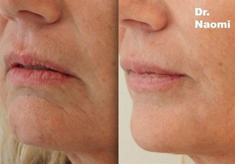 Lower third of face injections including Marionette Filler - Best Clinic Sydney for Dermal Fillers Marionette Lines Filler, Downturned Mouth, Lines Around Mouth, Face Injections, Smokers Lines, Face Fillers, Anti Wrinkle Mask, Marionette Lines, Hyaluronic Acid Fillers