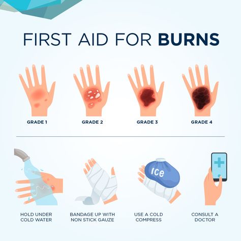 BURN FIRST AID 🔥 Contact with any source of heat can cause a burn or scald injury. A burn can result from contact with a heat source such as hot metal or electricity, hot liquid or steam. First Aid For Burns Poster, First Aid Study Notes, First Aid Notes, First Aid Infographic, Burn First Aid, Types Of Burns, First Aid For Burns, Chemical Burn, Burn Injury