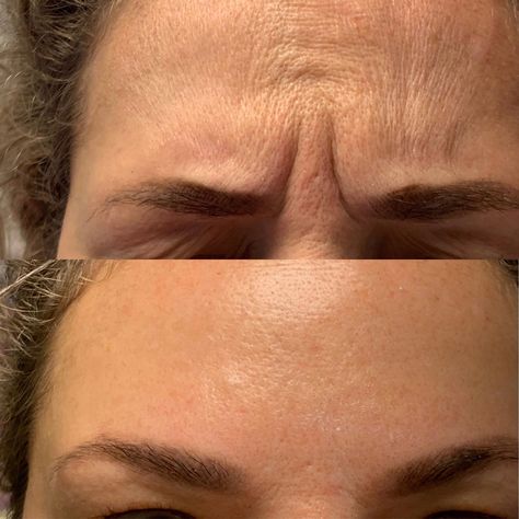 Botox Face Before And After, Face Botox Before And After, Wrinkles Before And After, Botox Frown Lines Before After, Forehead Botox Before And After, Before And After Botox Pictures, Fillers Before And After, Botox Before After, Botox Aesthetic