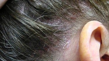 https://www.dryscalpgone.com/bumps-on-the-scalp-that-itch/  Bumps on the scalp that itch Heat Bumps, Scalp Bumps, Itchy Head, Small Pimples, Scalp Itch, Itchy Ears, Bump Hairstyles, Itchy Rash, Heat Rash