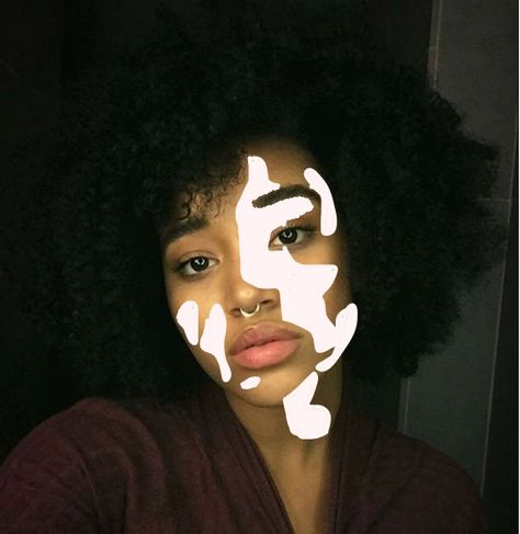 Vitiligo disorder on face Vilitigo Skin, Sims 4 Vitíligo Cc Patreon, Vitíligo Drawing, Sims 4 Vitíligo Cc, Skin Reference, Girls With Vitligo, Acne Solutions, Black Person, Tan Skin