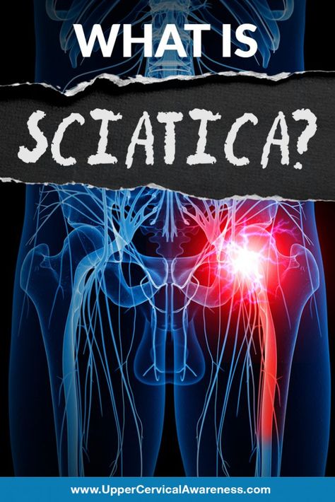 Upper Cervical Chiropractic, Sciatica Symptoms, Low Back Pain Relief, Sciatica Exercises, Piriformis Syndrome, Sciatica Relief, Sciatica Pain Relief, Back Stretches For Pain, Upper Back Pain