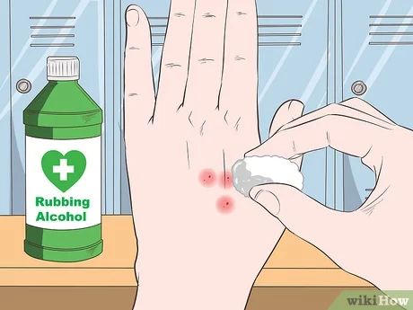 4 Ways to Stop Mosquito Bites from Itching - wikiHow Itching Skin Remedies, Mosquito Bite Itch Relief, Mosquito Bite Relief, Mosquito Bite Itch, Remedies For Mosquito Bites, Bug Bites Remedies, Diy Bug Repellent, Bite Relief, First Aid Tips