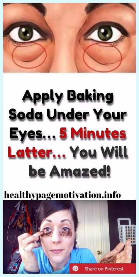 Apply Baking Soda Under Your Eyes…5 Minutes Latter…You Will be Amazed! Baking Soda Face, Baking Soda Benefits, Remove Dark Circles, Skin Care Wrinkles, Baking Soda Uses, Baking Soda Shampoo, Dark Circles Under Eyes, Under Eye Bags, Puffy Eyes