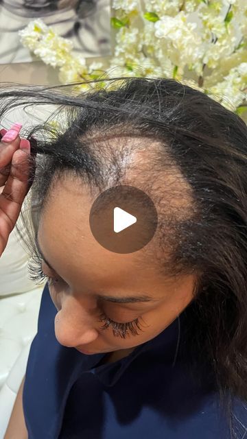 Cherie Amor on Instagram: "My client said Cherie I don’t want a perfect ponytail, I want it to look like it’s mines … She has Areata Alopecia which is an autoimmune condition that causes hair loss. It occurs when the immune system mistakenly attacks the hair follicles, leading to hair loss in small, round patches on the scalp or other areas of the body. Areata alopecia can affect people of all ages and genders, and the exact cause is unknown.  As you can see she has a head full of hair, I gave her a silk press so the frontal piece can blend in extremely well with her hair which it did perfectly. She has absolutely no pieces added to her ponytail and it’s giving very much it’s all her hair from the hair line to the  very end of her ponytail ❤️  We didn’t wanna go for the perfect sleek ponyt Glue In Hair Styles For Black Women, Quick Weave For Alopecia, Bald Spot Hairstyles For Women, Alopecia Tattoo Ideas, Ponytail With Closure, Alopecia Ponytail Hairstyles, Frontal Closure Ponytail, Hairstyles For Black Women With Alopecia, Hairstyles For Alopecia For Women