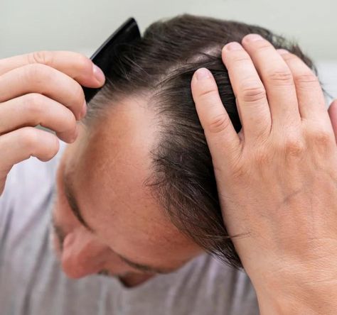 A man combing his hair, focusing on a receding hairline, showing thinning hair near the top of his head, highlighting hair loss. Shatavari Benefits, Excessive Hair Fall, Hormonal Imbalances, Ayurvedic Remedies, Hair Issues, Nutritional Deficiencies, People Struggle, Hair Texture, Thinning Hair