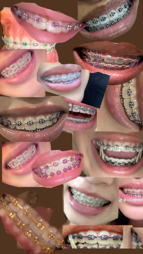 Braces Black Color, Black Braces Aesthetic, Black Braces Teeth, Aesthetic Braces, Perfect Teeth Braces, Braces Color Wheel, Pretty Makeup Ideas, Black Braces, Types Of Braces