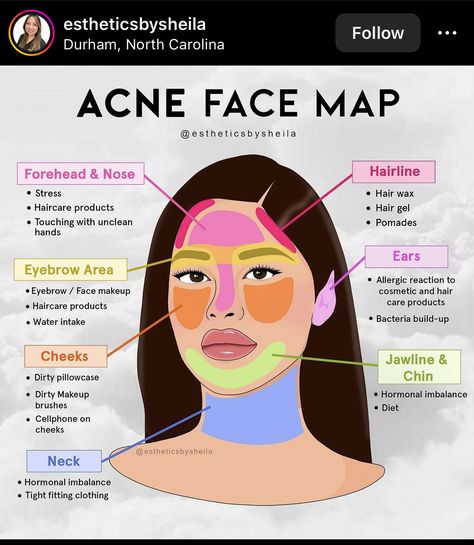 Acne Face Map, Face Map, Face Mapping Acne, Haut Routine, Face Mapping, Skin Advice, Skin Care Routine Order, Acne Face, Basic Skin Care Routine