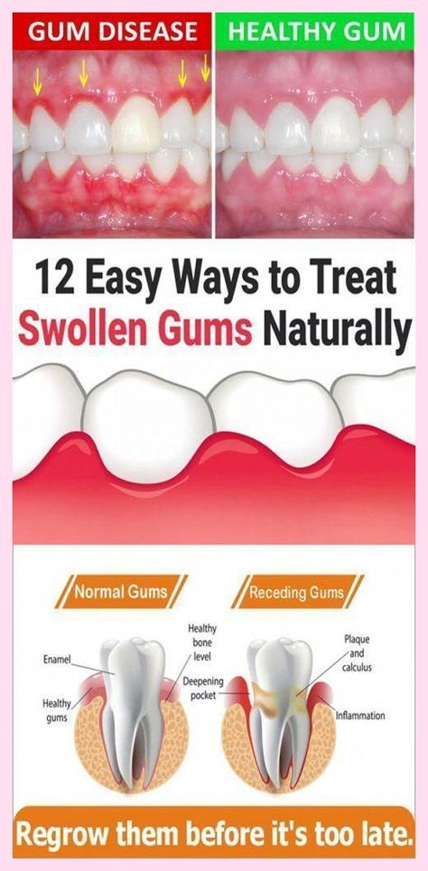 I appreciate your kind posts. Inestimable  tips Swollen Gum, Dental Cavities, How To Prevent Cavities, Medical Terminology, Receding Gums, Oral Care Routine, Periodontal Disease, Gum Care, Oral Health Care