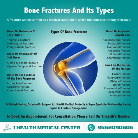 A fracture can be termed as a medical condition in which the bone's continuity is broken. Fractures are classified in numerous ways. To read more, please click the link ! Avulsion Fracture, Osteogenesis Imperfecta, Types Of Bones, Road Accident, Bone Fracture, General Practitioner, Orthopedic Surgeon, Bone Diseases, Types Of Cancers