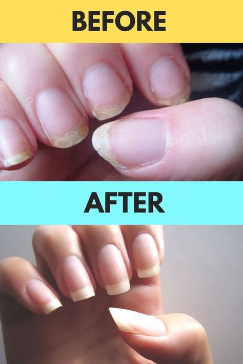 How To Get Long Nails Overnight At Home, How To Make Your Nails Grow Overnight, How To Grow Nails Faster In A Day, How To Get Long Nails Overnight, Nail Growth Tips Faster Overnight, How To Make Your Nails Grow Faster, How To Grow Nails Faster Overnight, Grow Nails Faster And Stronger, Nail Growth Remedies