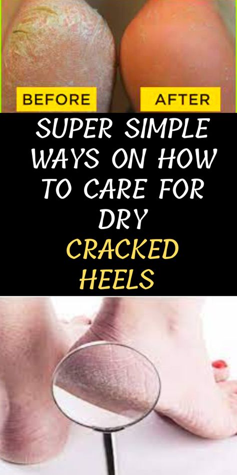 Dry Heel Remedies, Soft Feet Remedy, Cracked Heels Diy, Cracked Feet Remedies, Soften Heels, Remedies For Cracked Heels, Heal Cracked Heels, Cracked Heel Remedies, Feet Remedies