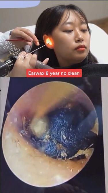 Earwax can interfere with hearing, cause infections and be downright uncomfortable. Excess wax can be safely removed by your healthcare provider through two common methods for optimal hearing: using a small, curved tool called a curet or employing suction techniques. #earwax #earwaxcleaning #earwaxremmoval #ears #earcells #aquapeace #KeereignFit Credit @earwaxworker5 #HomeRemediesToCureCold Best Ear Wax Removal, Ear Wax Removal Video, Losing 40 Pounds, Ear Wax Removal, Natural Sleep Remedies, Natural Cold Remedies, Get Rid Of Blackheads, Cold Home Remedies, Natural Cough Remedies