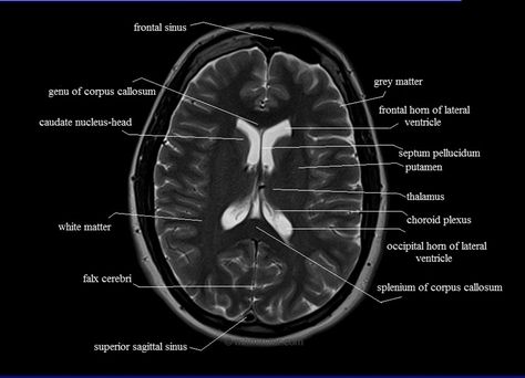 MRI anatomy brain axial image 17 Mri Study Guide, Mri Anatomy, Brain Mri, Mri Brain, Radiology Student, Radiology Imaging, Brain Surgeon, Brain Images, Cerebral Cortex