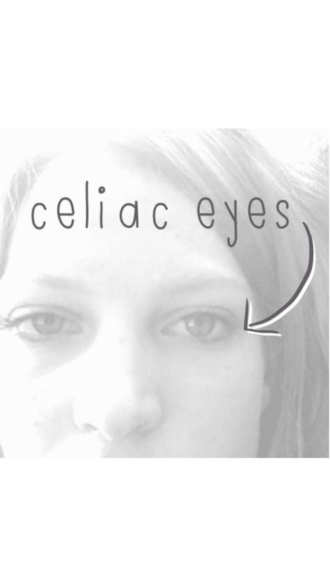 What+I+want+you+to+know+about+celiac+disease+-+inspiredrd.com Celiac Safe Foods, Celiac Eyes, Symptoms Of Celiac, Celiac Symptoms, Celiac Diet, Kitchen Checklist, Gluten Free Meals, Celiac Recipes, Comfort Casseroles