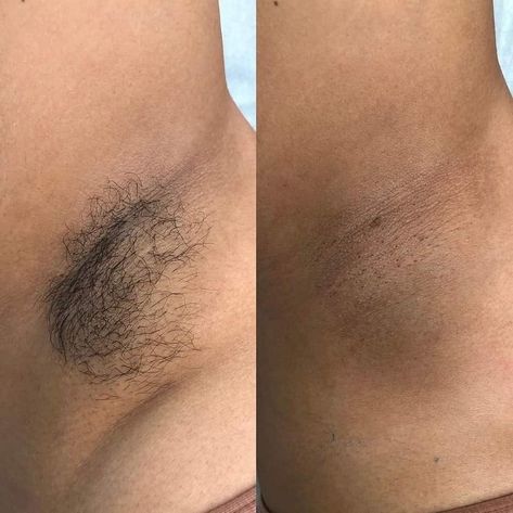 Hairless, smooth underarms is definitely a plus! Whatcha think!?? 509-961-6555 #underarmwax #hairfree #waxstudio #hairless #waxspecialist #yakima #bebare #bodywaxspecialist #nomorehair #bodywax #femalewaxing #malewaxing #yakimawaxing #fromheadtotoe #barebliss #beauty #bodywaxing #waxingstudio #waxingspecialist #waxingyakima #fullbodywax #underarmwaxing #hairremoval #fullbodywaxing Female Waxing, Male Waxing, Underarm Waxing, Full Body Wax, Remedies For Acne, Wax Studio, Waxing Tips, Healthy Face, Underarm Hair Removal