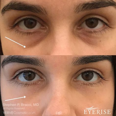 Eye Bag Surgery, Eye Bag Removal, Under Eye Lines, Bags Under Eyes, Skin And Makeup, Types Of Belly Fat, Remove Dark Circles, Under Eyes, Dark Circles Under Eyes