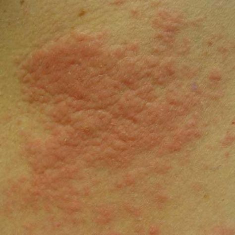 Hives, also know as urticaria, are a common cause of itchy rashes.  Find out what hives looks like in these hives pictures. Rash On Stomach, Skin Rash Remedies, Skin Rashes Pictures, Allergic Reaction Rash, Hives Rash, Types Of Skin Rashes, Common Skin Rashes, Allergy Rash, Fungal Rash