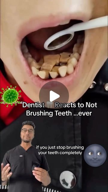 Dentistry on Instagram: "Post by • @dentite313 This a rare case of never brushing your teeth 🦷 why this occurs, bacteria 🦠 will overtake the mouth . And it will “derode “ the teeth , bone and gums. Meant to say deteriorate but derode stuck in my head 🤣" Tartar Removal From Teeth, Teeth Tartar Removal, Teeth Bonding, Rotten Teeth, Teeth Diseases, Tartar Teeth, Plaque Teeth, Tartar Removal, Dental Health Care