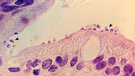 32 scary parasitic diseases | Live Science Parasite Pictures, Diseases Pictures, Human Tissue, Health Images, Science News, Human Behavior, Health Professionals, Public Health, Public Domain