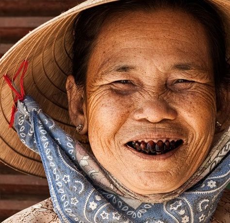 Dentaltown - Diagnosis? The effects of betel nut on the teeth often show red stained lips and teeth from constant chewing of betel nut, which is a natural stimulant like nicotine. Betel nut is another term for areca nut. Using betel nut has many harmful effects on health and is carcinogenic to humans. Military Slang, Health Care Tips, Black Teeth, Betel Nut, Vietnam History, Vietnam Vets, History Magazine, Philips Sonicare, South Vietnam