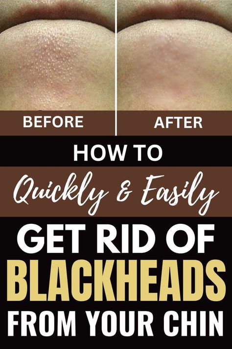 How to Quickly and Easily Get Rid of Blackheads From Your Chin at Home Lost 40 Pounds, Rid Of Blackheads, Cold Medicine, Home Remedy For Cough, Cold Sores Remedies, Types Of Acne, Remove Blackheads, Weight Changes, Natural Cold Remedies