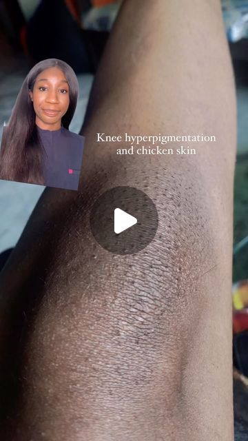 Dark Knees Remedy Fast, Glycolic Acid Before And After, Body Retinol, Ashy Knees, Glowing Body Skin, Skin Care Hyperpigmentation, Dark Knees, Smooth Glowing Skin, Exfoliating Body Wash