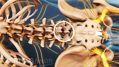 Microdiscectomy Recovery, Lower Right Back Pain, Severe Back Pain, Sciatica Pain Relief, Spine Health, Spine Surgery, Sciatic Nerve Pain, Sciatica Pain, Sciatic Nerve