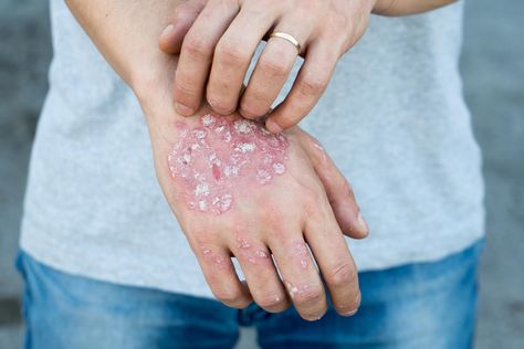 Immunotherapy strategy offers hope to autoimmune skin disease sufferers Home Remedies For Skin, Dry Flaky Skin, Skin Disorders, Flaky Skin, Skin Diseases, Natural Treatments, Skin Conditions, Doterra, Disease