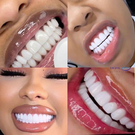 Pretty Teeth Smile Aesthetic, Veneers Black Women, Pretty Teeth Smile, Dream Teeth, Gem Teeth, Veneer Teeth, Teeth Veneers, Teeth Surgery, Teeth Aesthetic