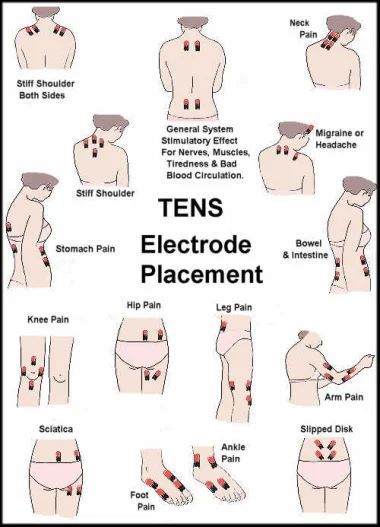 TENS is an acronym for Transcutaneous Electrical Nerve Stimulator. This device is used to deliver an electric current through electrodes that are placed on the skin. | Tens Electrode Placement, Tens Unit Placement, Tens And Units, Tens Machine, Tens Unit, Ten Unit, Ankle Pain, Back Pain Remedies, Sciatic Nerve Pain Tens Electrode Placement, Tens Unit Placement, Nerve Pain Remedies, Tens And Units, Tens Machine, Tens Unit, Nerve Health, Chronic Pain Relief, Ten Unit