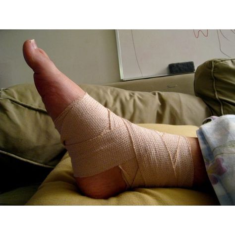 How Long Does a Sprained Ankle Take to Heal? Sprained Ankle Remedies, Ankle Sprain Recovery, Patellar Tendon, Ankle Fracture, Ankle Exercises, Twisted Ankle, Broken Finger, Bicep Muscle, Ankle Surgery