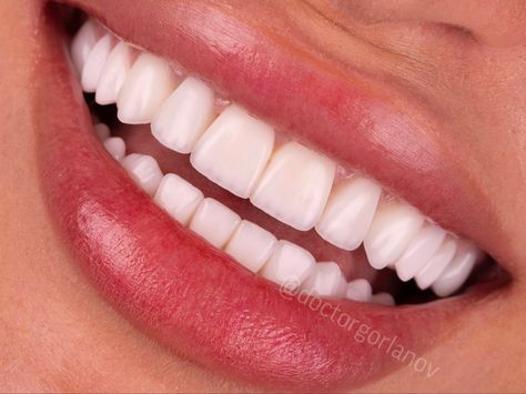 White Teeth Pictures, Small Teeth Smile, Perfect Smile Teeth Women, Natural White Teeth, Pearly White Teeth, Good Teeth, Cute Teeth, Perfect Skin Routine, Teeth Aesthetic