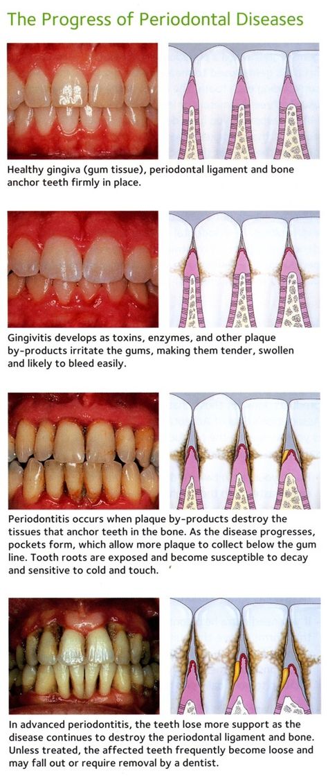 Evolución #periodontitis #dentista www.clinicadentalmagallanes.com Dental Assistant Study, Dental World, Dental Hygiene School, Dental Anatomy, Dental Fun, Dental Facts, Dental Life, Dental Products, Dental Humor