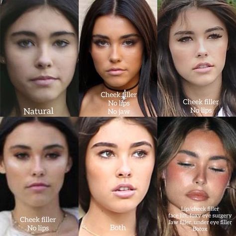 Brows And Lips Makeup, Jaw Implant Before And After, Madison Beer Plastic Surgeries, Jaw And Chin Filler, Eyebrow Botox Lift, Filler Nose Job Before After, How To Lift Your Eyes, Madison Beer Lip Fillers, Hip Filler Before And After