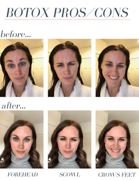 jillgg's good life (for less) | a west michigan style blog: botox Q & A... the pros and cons and my HONEST opinion about it! Botox Before And After, Botox Face, Mole Removal, Homemade Face Masks, Homemade Face, Unwanted Hair Removal, West Michigan, Double Chin, Unwanted Hair