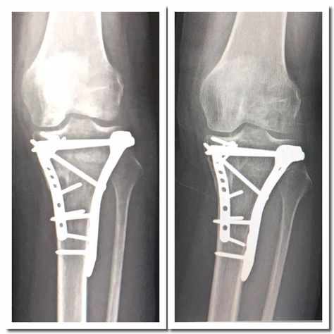 Tibial Plateau Fracture Recovery, Tibial Plateau Fracture, Bone Fracture, Muscle Atrophy, Surgical Technologist, Ankle Pain, Simple Tattoos For Guys, Orthopedic Surgery, Knee Surgery