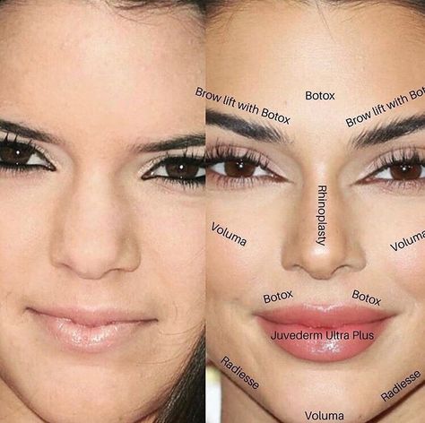 Kendall Jenner Plastic Surgery, Face Plastic Surgery, Botox Brow Lift, Rhinoplasty Nose Jobs, Face Fillers, Facial Fillers, Facial Contouring, Facial Aesthetics, Cosmetic Dermatology