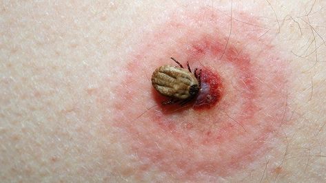 Here’s how you know you’ve been bitten by a tick, how to safely remove the tick, and when to see a doctor. Precautions must be taken if you suspect a tick bite, as it can lead to serious problems, such as Lyme disease and other infections. Tick Bite Symptoms, Tick Bite, Sjogrens Syndrome, Mosquito Bite, Bug Bites, Menstrual Cramps, Dry Eyes, Ticks, How To Know