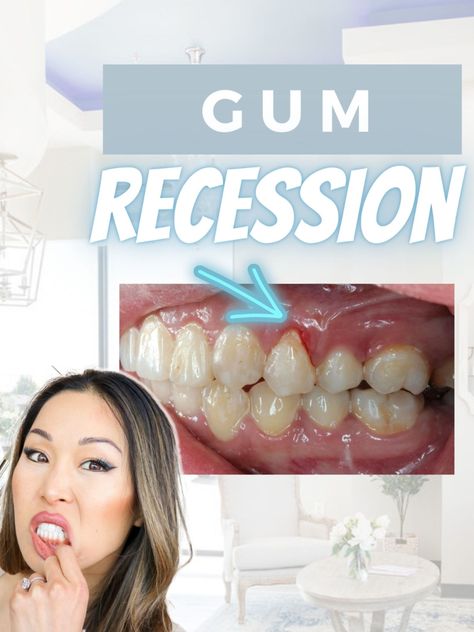 How to treat and prevent gum recession. Mouth Hygiene, Healthy Heart Tips, Gum Recession, Dental Teeth, Receding Gums, Dental Insurance, Teeth Care, Tooth Decay, Oral Hygiene