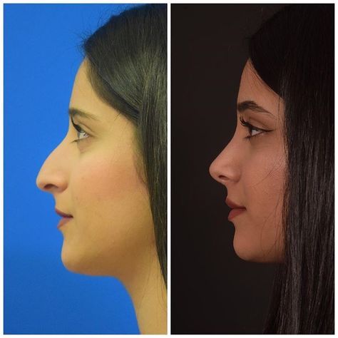 Natural Nose Job Rhinoplasty, Nostril Surgery, Pimple Inside Nose, Acne On Nose, Nose Plastic Surgery, Bulbous Nose, Plastic Surgery Fail, Rhinoplasty Nose Jobs, Nose Reshaping