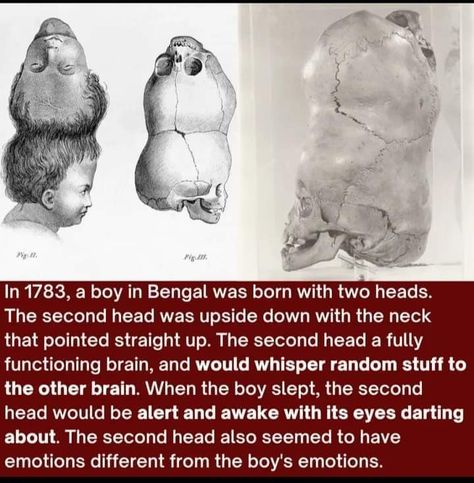 Weird History Facts, Conjoined Twins, Curious Facts, Scary Facts, Creepy Facts, History Facts Interesting, Army Veteran, Science Facts, Interesting History