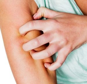 Beware Skeeter Syndrome: Mosquito Bites That Won’t Quit | The People's Pharmacy Skeeter Syndrome, Mosquito Bite Itch, Remedies For Mosquito Bites, Michelle Phan, Snoring Solutions, Best Teeth Whitening, Mosquito Bite, Insect Bites, Itchy Skin