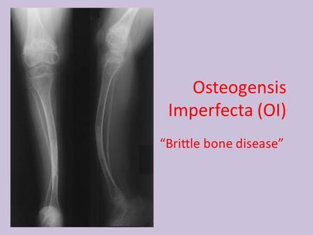 Osteogensis Imperfecta (OI) “Brittle bone disease”> Osteogenesis Imperfecta, Bone Fracture, Heart Defect, Body Image Issue, Bone Diseases, Mental Health Counseling, Reconstructive Surgery, Hearing Loss, Collagen Production