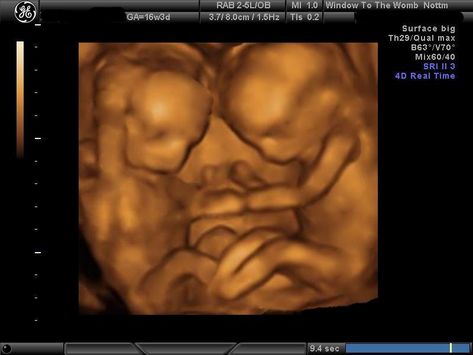 Tiny 16 week 3d ultrasound images. Identical Twins Ultrasound, Twin Baby Loss, Twins In The Womb, Twins Ultrasound, Baby Ultrasound Pictures, 3d Ultrasound, Mommy And Baby Pictures, Baby Ultrasound, Ultrasound Tech